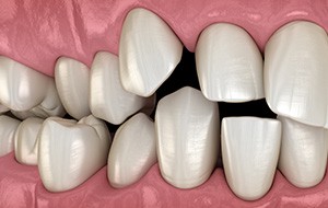 Illustration of spaced out teeth