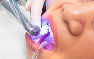 Dentist in Jacksonville applying dental sealant to a child's tooth 