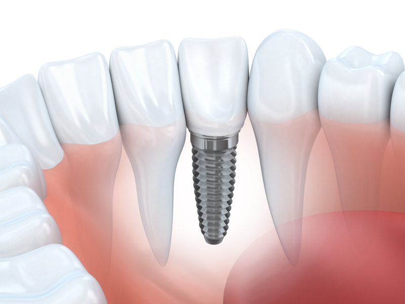 Want Dental Implants in Jacksonville, FL? Here’s What to